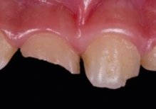 Kondisi Gigi Anak ADHD 1