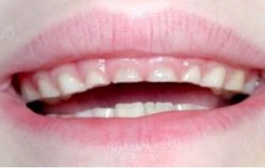 Kondisi Gigi Anak ADHD 3