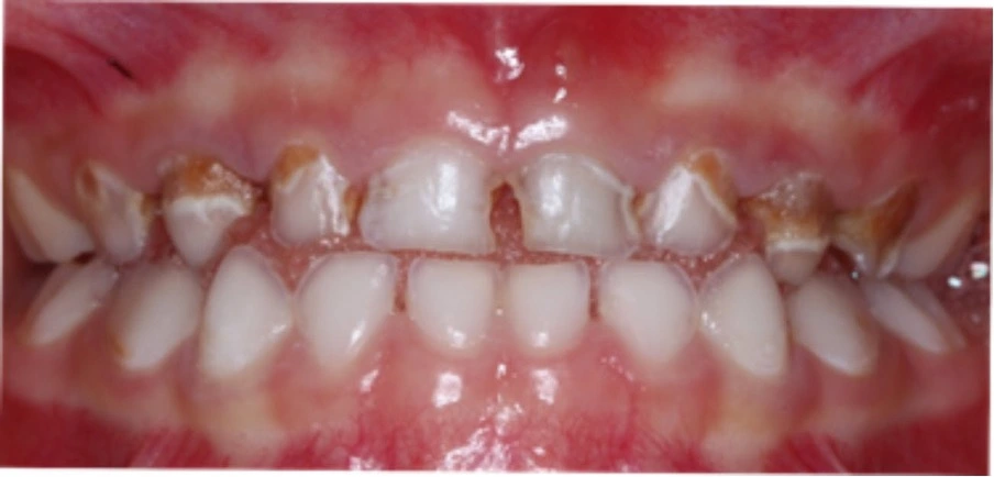 Kondisi Gigi Anak ADHD 4