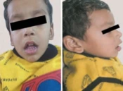 Bernapas Melalui Mulut - Mouth Breathing 1