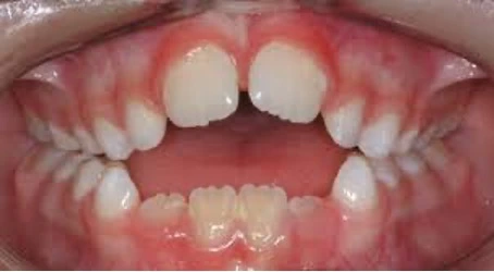 Bernapas Melalui Mulut - Mouth Breathing 2