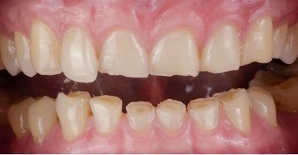 Bruxism - Menggemertakkan Gigi