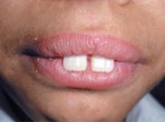 Menggigit Bibir - Lip Biting 1