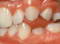 Mendorong Lidah - Tongue Thrusting 2