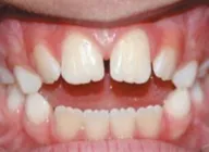 Menghisap Jari - Thumb Sucking 2