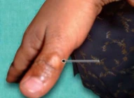 Menghisap Jari - Thumb Sucking 3