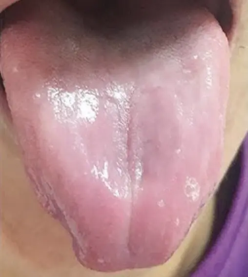 Ilustrasi Atrophic Glossitis atau Lidah Botak