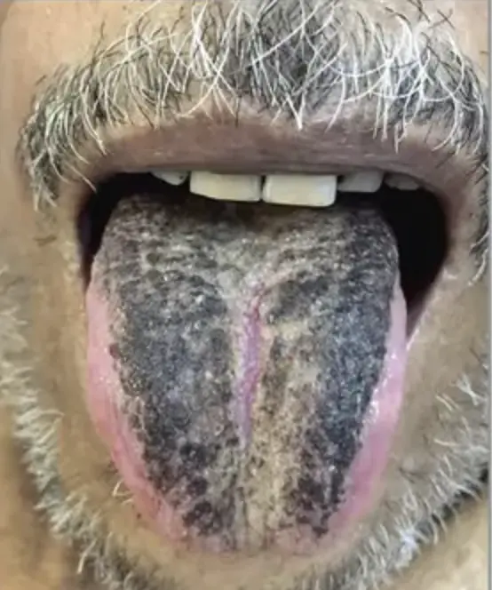 Ilustrasi Hairy Tongue atau Lidah Berbulu