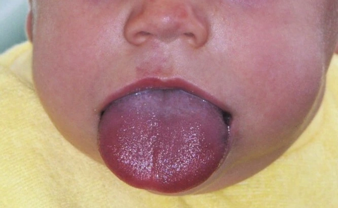 Ilustrasi Macroglossia atau Lidah Besar