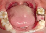 Space Maintainer Semi Cekat