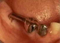 Space Maintainer Semi Cekat 2