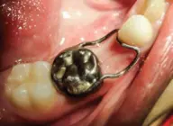 Space Maintainer Semi Cekat 3